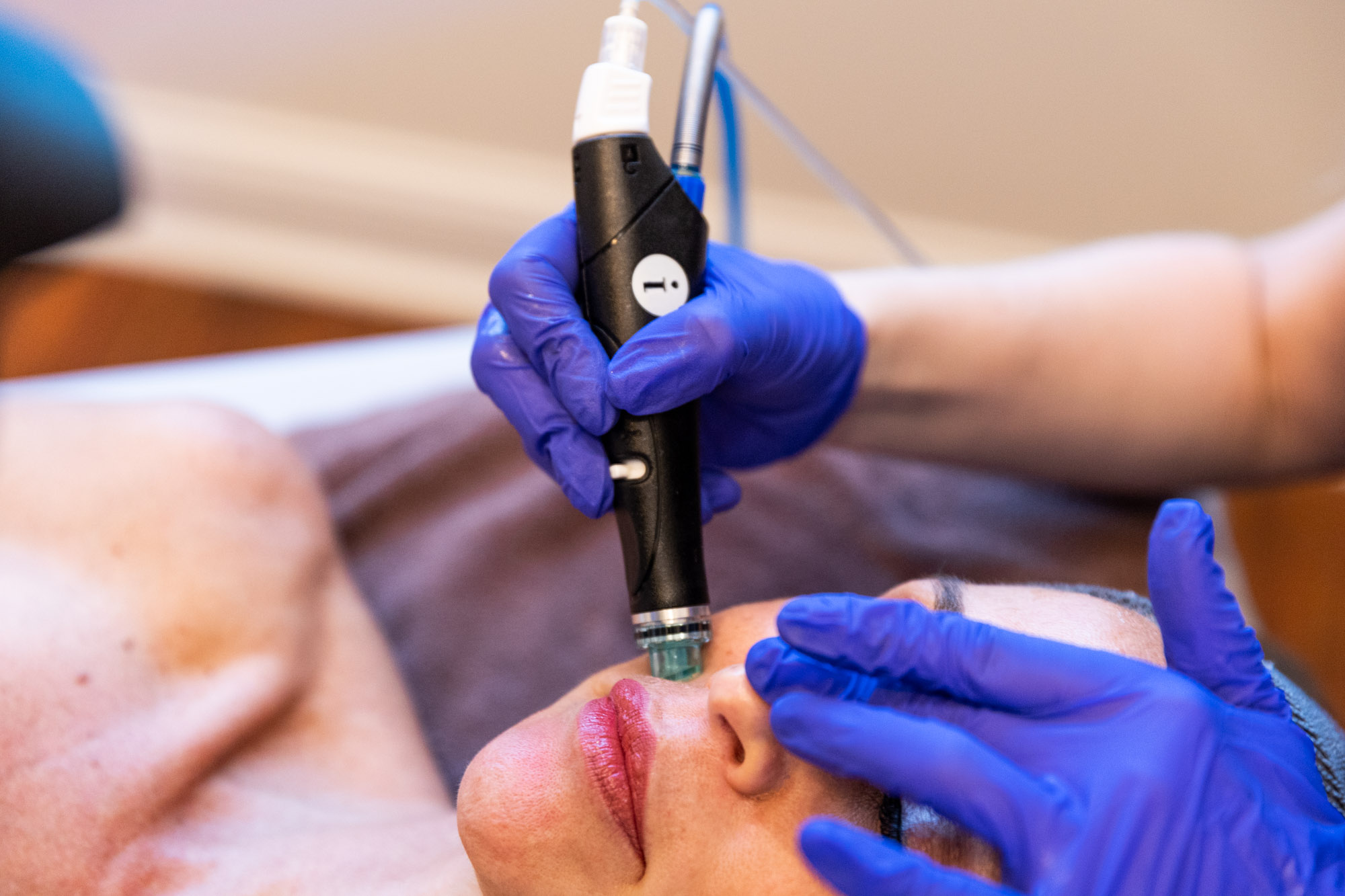 HydraFacial treatment process for the best skin care in North Myrtle Beach