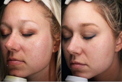 CO2 Laser Treatment Before & After