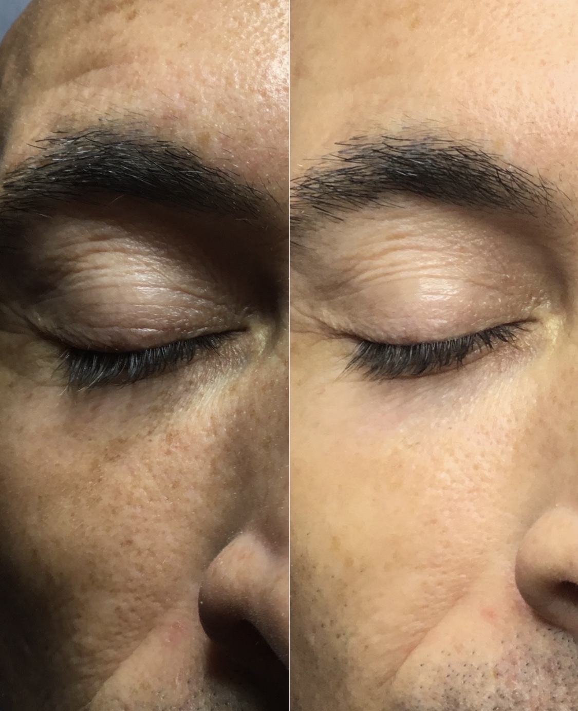 CO2 Laser Before & After