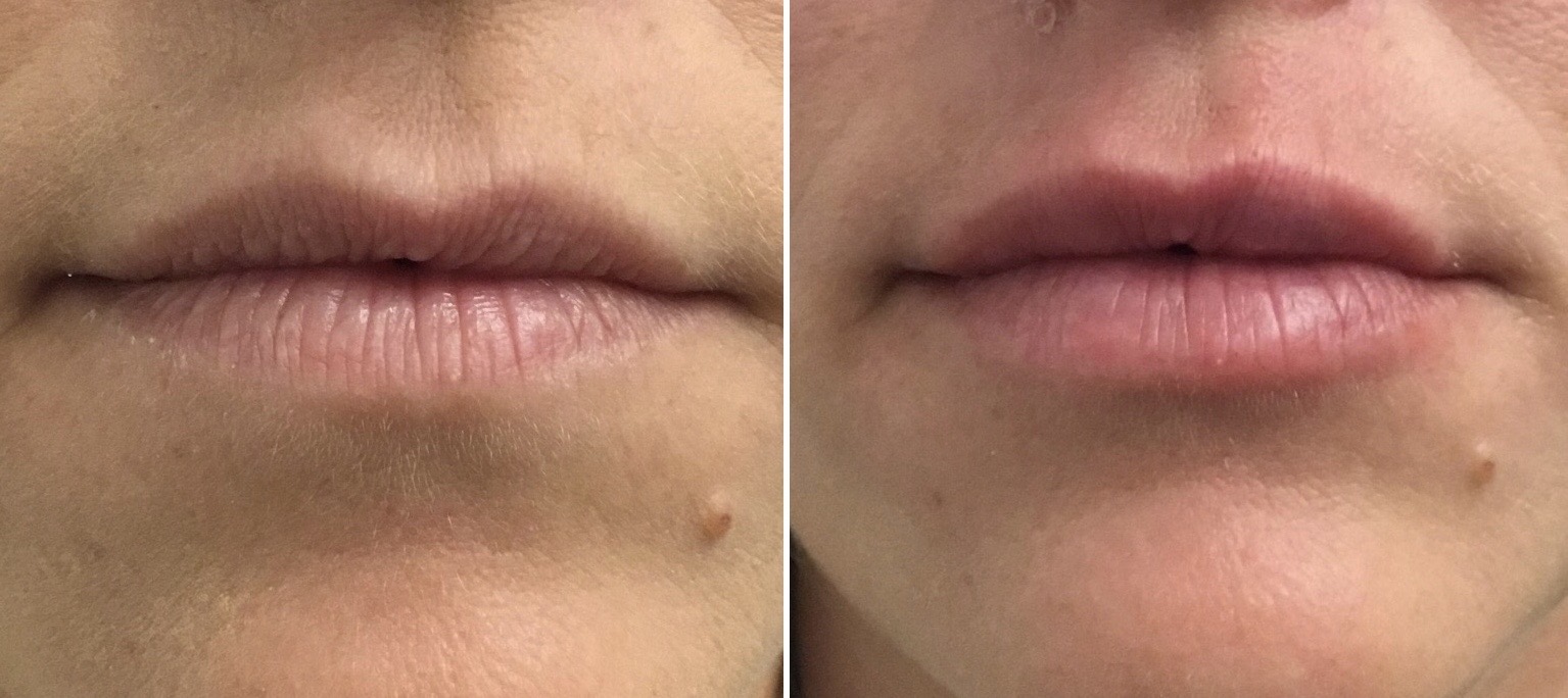 Lip Filler 25 Touch MedSpa