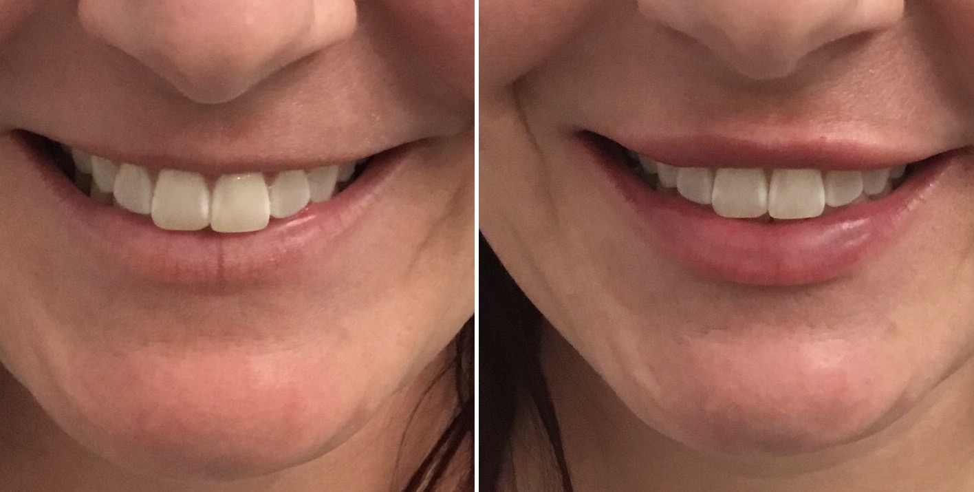 Lip Filler 29 Touch MedSpa