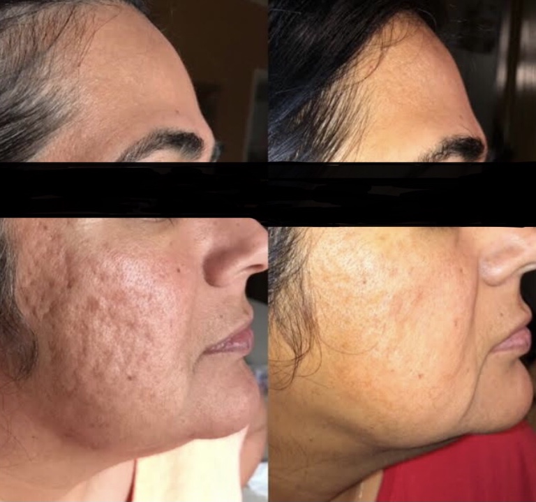 Best CO2 Laser Resurfacing Near Me